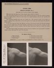 Upper Limb. Surface Anatomy - no. 2